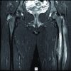 Chronic Recurrent Multifocal Osteomyelitis: A Case Report with Atypical Presentation