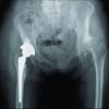 Insufficiency Fractures of the Distal Tibia and Fibula Following Total Hip Arthroplasty: A Case Report