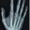 Case Report: Oblique Fracture of the Ulnar Sesamoid Bone of the Metacarpophalangeal Joint, a Rare Pathology