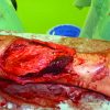 A Gustilo Type 3B Open Tibial Fracture Treated with a Proximal Flexor Hallucis Longus Flap: A Case Report