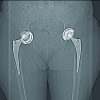 Aseptic Loosening after Total Hip Arthroplasty in an Acromegalic Patient: A Case Report
