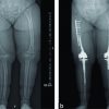 Two-staged Bilateral, Femoral Alignment Osteotomy with Concomitant Total Knee Arthroplasty in an Achondroplasia Patient – A Case Report