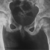 Synovial Chondromatosis: A Rare Differential Diagnosis of Hip Pain in a Child