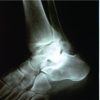 Retrocalcaneal Bursitis due to Rare Calcaneal Osteochondroma in Adult Male : Excision and Outcome