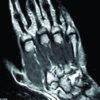 Hamulus Stress Fracture in a Batsman: An Unusual Injury in Cricket – A Case report and Review of Literature