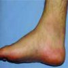 An Exceptional Case of Suture Granuloma 30 Years Following an Open Repair of Achilles Tendon Rupture: A Case Report