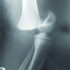 Uncommon Floating Knee in a Teenager: A Case Report of Ipsilateral Physeal Fractures in Distal Femur and Proximal Tibia