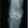Closed Reduction of “Irreducible” Posterolateral Knee Dislocation – A Case Report