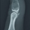 Curettage Using Soft-wire for Enchondroma in the Hand: A Technical Note