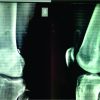 Retained Drain after Anterior Cruciate Ligament Surgery : A Silent Threat to an Athlete’s Career: A Case Report