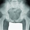 Focal Periphyseal Edema Zone on Magnetic Resonance Imaging in the Greater Trochanter Apophysis: A Case Report