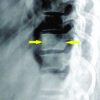 A Case Report: Upper Thoracic Chance Fracture with Monoplegia… An Unusual Presentation!