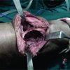 Articular Reconstruction using Subchondral Cementation and Threaded Kirschner-wires in Giant Cell Tumor: A Novel Technique