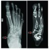 Insufficiency Fractures at Unusual Sites: A Case Series