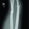 Radius and Ulna Stress Fractures in a Patient with Neuromyelitis Optica: A Case Report
