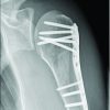 Bilateral Anterior Shoulder Dislocation in the Elderly – A Case Report and Review of the Literature