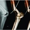 Head-on Allograft Transplantation: A Unique Case Report Where a Large Piece of Femoral Bone was Extruded from One Patient’s Body and Impaled Another Patient’s Tibia