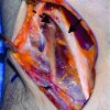 Anterior Elbow Pain Caused by Compression of the Lateral Antebrachial Cutaneous Nerve