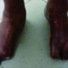 Subtotal Calcanectomy for the Treatment of Chronic Ulcer Associated with Osteomyelitis: A Case Report