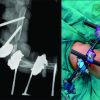 As a Definitive Choice of Treatment, Joint and Defect Spanning Multiplanar Tubular External Fixation in the Management of Pediatric Open Defective Supracondylar Humerus Fracture: A Case Report