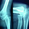 Isolated Pure Lateral Dislocation of Elbow in a 9-year-old Child: A Rare Case Report