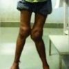 A Case Report of Primary Synovial Chondromatosis with Bilateral Genu Valgum