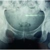 Late and Vague Presentation of Septic Arthritis of Hip in a IVDrug Abuser