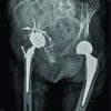 Acetabular Fracture after Hip Hemiarthroplasty: One Stage Procedure to a Total Hip Arthroplasty after Stabilization of the Fracture by Means of Cerclage Wires