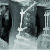 A Unique Case of Cervical Myelopathy in an Adult Patient with Scheie Syndrome