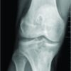 Multiple Recurrent Cyst Formation after Anterior Cruciate Ligament Reconstruction – A Case Report
