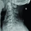 Unusual Presentation of Spinal Gout: 2 Cases Report and Literature Review