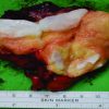 An Intramuscular Chondrolipoma of the Scapula: A Case Report of a Rare Tumor in an Unusual Location