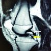 Double Posterior Cruciate Ligament Sign on Magnetic Resonance Imaging: Imaging Variants, Mimics, and Clinical Implications
