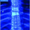 Mycobacteria Intracellulare Spondylodiscitis Presenting as Progressive Consecutive Vertebral Sclerosis: A Case Report