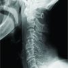 Combined Fractures Involving the Odontoid and Unilateral Superior Articular Processes of the Axis: A Report of Three Cases and Literature Review
