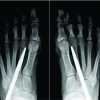 A Case Report of Spontaneous Second Toe Varus Deformity Correction after Hallux Valgus Deformity Correction by a Non-osteotomy Technique: Syndesmosis Procedure
