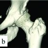 Arthroscopic Treatment for Femoral Nerve Palsy Associated with Ganglion Cyst of the Hip: A Case Report