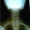 Thoracic Outlet Syndrome from Bilateral Cervical Ribs -A Clinical Case Report