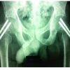 Simultaneous, Non-traumatic, Bilateral Neck Femur Fractures in Uremic Renal Osteodystrophy: A Report of Three Cases and Literature Review