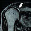 Arthroscopic Superior Capsule Reconstruction for Irreparable Rotator Cuff Tear and Axillary Nerve Palsy Associated with Anterior Dislocation of the Shoulder
