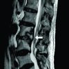 A Case Report of Vertebral Osteomyelitis Caused by Peptostreptococcus micros