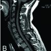 Bone Involvement Mimicking an Aggressive Bone Lesion in a Diffuse-type Tenosynovial Giant Cell Tumor in the Thoracic Vertebral Lamina: A Case Report