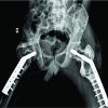 A Case of Fibrous Dysplasia with Bilateral Shepherd Crook Deformity Treated with Dynamic Hip Screw Fixation