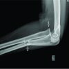 Adult Monteggia Lesion with Ipsilateral Distal Radius Fracture: A Case Report and Review of the Literature