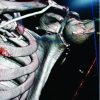 Transcoracoid Screw Fixation for Ideberg Type 3 Glenoid Fracture: Surgical Technique