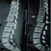 Rare Case of Bilateral Pure Facet Joint Dislocation of Upper Lumbar Spine without Facet Fracture: A Case Report