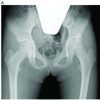 Hip arthroscopic Surgery after a Diagnosis of Premature Osteoarthritis of the Hip in Three Unicyclists: A Case Series