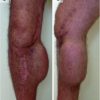 Soft-Tissue Expansion beforeTotal Knee Arthroplasty:A Report of Two Cases
