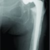 Progressive Osteolysis with Hematoma Following Revision Total Hip Arthroplasty using Hydroxyapatite Mesh: A Case Report