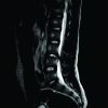 Limbus Vertebral Fracture Presenting as Cauda Equina Syndrome Masquerading An Acute Disc Prolapse – A Rare Case Report and Review of Literature